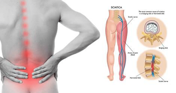 douleur sciatique chronique
